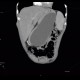 Small cell lung carcinoma, SCLC, metastasis in pancreas, after therapy: CT - Computed tomography