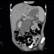 Small cell lung carcinoma, SCLC, metastasis in pancreas, after therapy: CT - Computed tomography