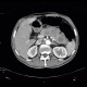 Small cell lung carcinoma, SCLC, metastasis in pancreas: CT - Computed tomography