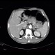 Small cell lung carcinoma, SCLC, metastasis in pancreas: CT - Computed tomography