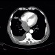 Small cell lung carcinoma, SCLC, metastasis in pancreas: CT - Computed tomography