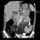 Small cell lung carcinoma, SCLC, metastasis in pancreas: CT - Computed tomography