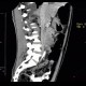 Small cell lung carcinoma, SCLC, metastasis in pancreas: CT - Computed tomography