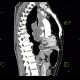 Small cell lung carcinoma, SCLC, metastasis in pancreas: CT - Computed tomography