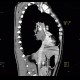 Small cell lung carcinoma, SCLC, metastasis in pancreas: CT - Computed tomography