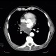 Small cell lung carcinoma, SCLC, metastasis in pancreas: CT - Computed tomography