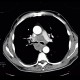 Small cell lung carcinoma, SCLC, metastasis in pancreas: CT - Computed tomography