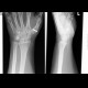 Metalosis, Bennet's fracture, repair: X-ray - Plain radiograph