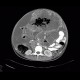 Metastasis of malignant melanoma in peritoneal cavity: CT - Computed tomography