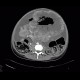 Metastasis of malignant melanoma in peritoneal cavity: CT - Computed tomography