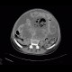 Metastasis of malignant melanoma in peritoneal cavity: CT - Computed tomography