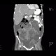 Metastasis of malignant melanoma in peritoneal cavity: CT - Computed tomography