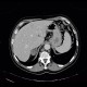 Collision tumour, adrenal adenoma, metastasis: CT - Computed tomography