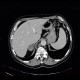 Collision tumour, adrenal adenoma, metastasis: CT - Computed tomography