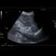 Collision tumour, adrenal adenoma, metastasis: US - Ultrasound