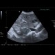 Collision tumour, adrenal adenoma, metastasis: US - Ultrasound