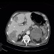 Neuroendocrine tumour of adrenal gland, liver metastasis, necrotic: CT - Computed tomography