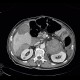 Neuroendocrine tumour of adrenal gland, liver metastasis, necrotic: CT - Computed tomography