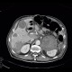 Neuroendocrine tumour of adrenal gland, liver metastasis, necrotic: CT - Computed tomography