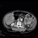 Neuroendocrine tumour of adrenal gland, liver metastasis, necrotic: CT - Computed tomography