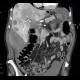 Neuroendocrine tumour of adrenal gland, liver metastasis, necrotic: CT - Computed tomography