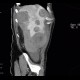 Neuroendocrine tumour of adrenal gland, liver metastasis, necrotic: CT - Computed tomography