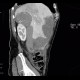 Neuroendocrine tumour of adrenal gland, liver metastasis, necrotic: CT - Computed tomography