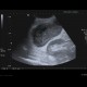 Neuroendocrine tumour of adrenal gland, liver metastasis, necrotic: US - Ultrasound