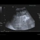 Neuroendocrine tumour of adrenal gland, liver metastasis, necrotic: US - Ultrasound