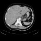 Liver metastases: CT - Computed tomography