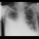 Metastatic lung disease, pleural effusion: X-ray - Plain radiograph