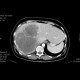 Liver metastasis, huge: CT - Computed tomography