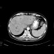 Metastatic disease of the liver, stomach carcinoma: CT - Computed tomography