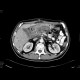 Metastatic disease of the liver, stomach carcinoma: CT - Computed tomography