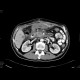 Metastatic disease of the liver, stomach carcinoma: CT - Computed tomography