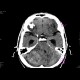 Cerebellar metastasis: CT - Computed tomography