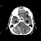 Cerebellar metastasis: CT - Computed tomography