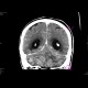 Cerebellar metastasis: CT - Computed tomography