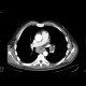 Metastases of lung and mediastinum: CT - Computed tomography