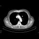 Grawitz tumor, renal cell carcinoma, metastatic disease: CT - Computed tomography