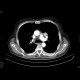 Grawitz tumor, renal cell carcinoma, metastatic disease: CT - Computed tomography