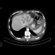 Grawitz tumor, renal cell carcinoma, metastatic disease: CT - Computed tomography