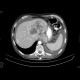 Grawitz tumor, renal cell carcinoma, metastatic disease: CT - Computed tomography