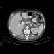 Grawitz tumor, renal cell carcinoma, metastatic disease: CT - Computed tomography