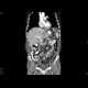 Grawitz tumor, renal cell carcinoma, metastatic disease: CT - Computed tomography