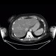 Liver metastasis, steatosis of liver, fatty liver, hepatopathy, correlation: CT - Computed tomography