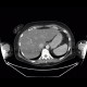 Liver metastasis, steatosis of liver, fatty liver, hepatopathy, correlation: CT - Computed tomography