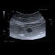 Liver metastasis, steatosis of liver, fatty liver, hepatopathy, correlation: US - Ultrasound