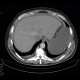 Renal carcinoma, tumorous thrombosis of inferior vena cava, pericardial metastasis: CT - Computed tomography
