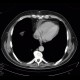 Renal carcinoma, tumorous thrombosis of inferior vena cava, pericardial metastasis: CT - Computed tomography